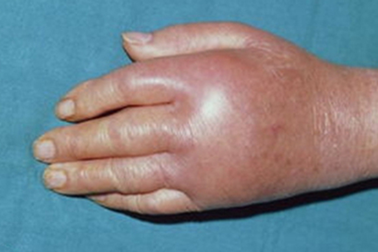 痛风手背红肿发亮图