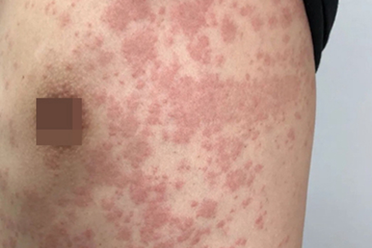 玫瑰糠疹肋部症状图 玫瑰糠疹肋部症状图