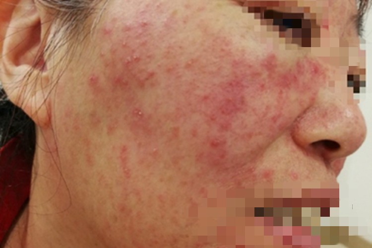 亚急性接触性皮炎面部症状图