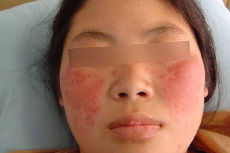面部蝶形红斑图