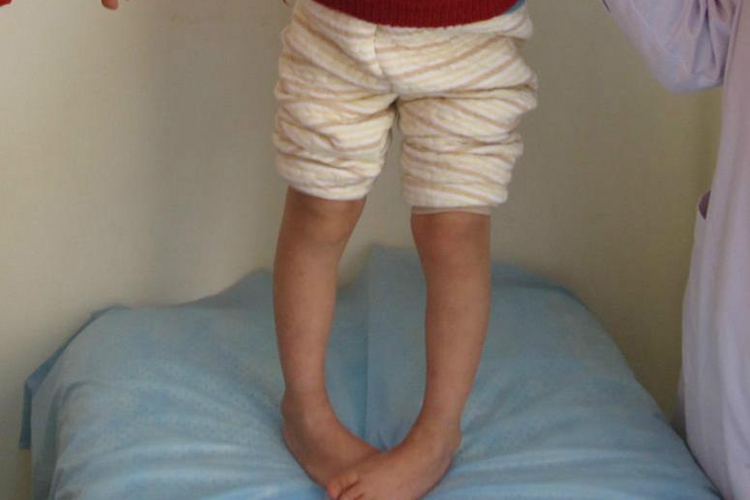 脑瘫婴儿直立位剪刀样图