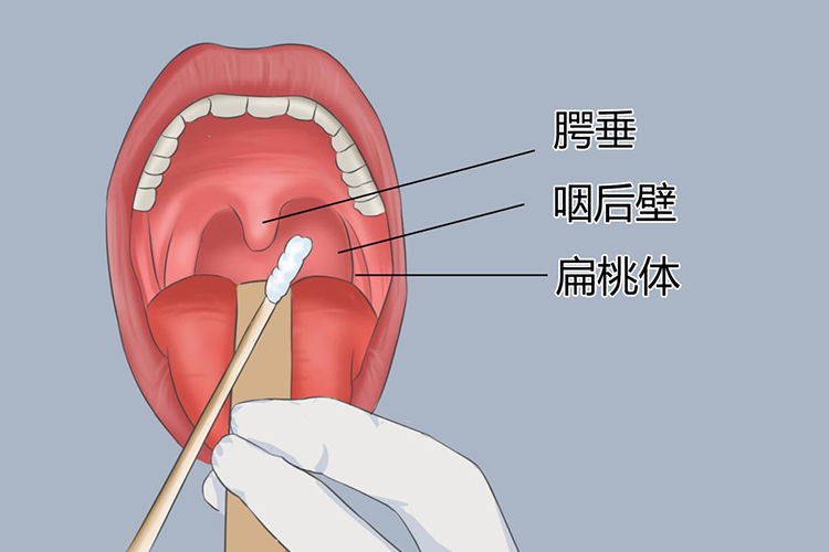 腭弓位置图咽拭子采样的具体部位为两侧腭弓,咽后壁及咽扁桃体.