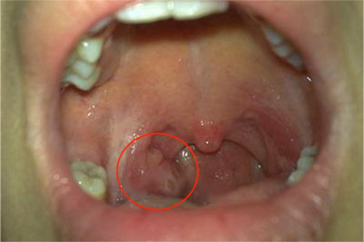 扁桃体癌扁桃体症状图 扁桃体癌扁桃体症状图