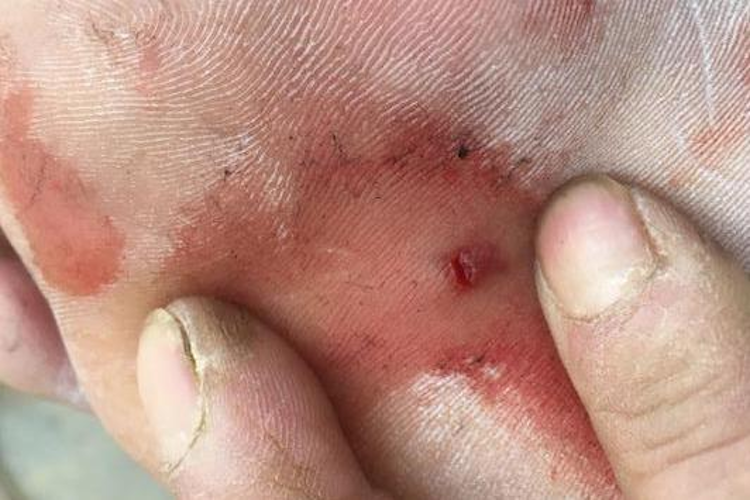 脚踩钉子伤口图
