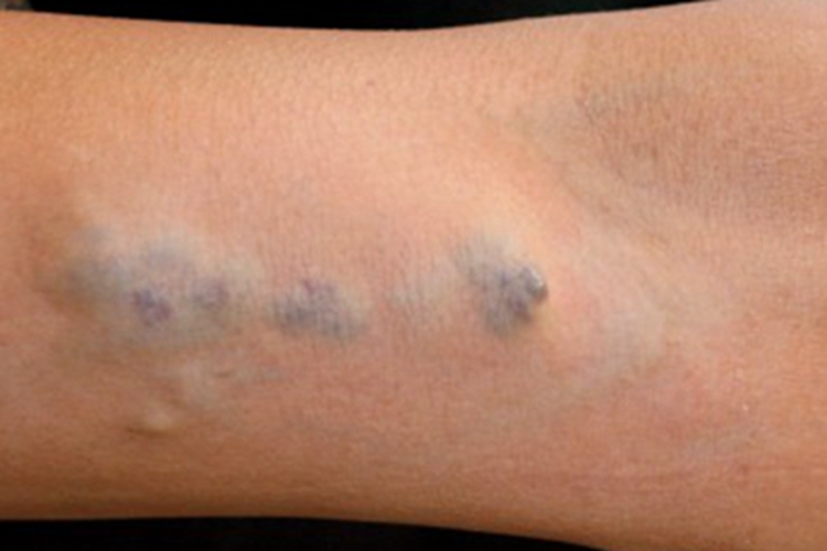 血管瘤手腕皮肤发青图