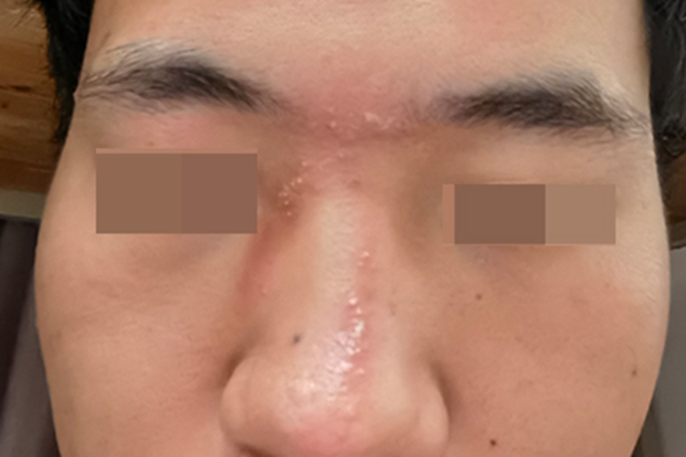 急性接触性皮炎面部小疙瘩图