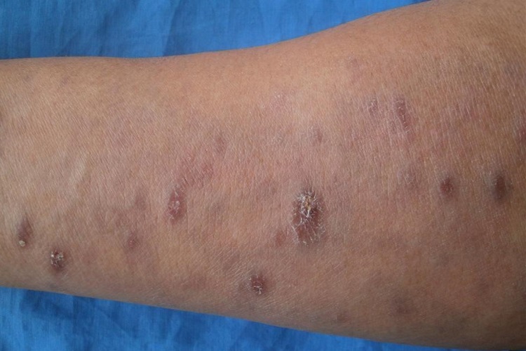 扁平苔藓样药疹大腿症状图