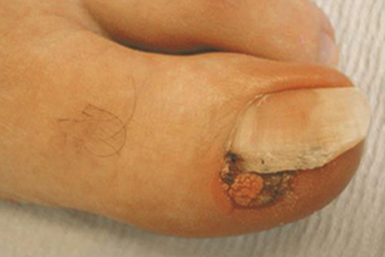 寻常疣脚趾甲症状图