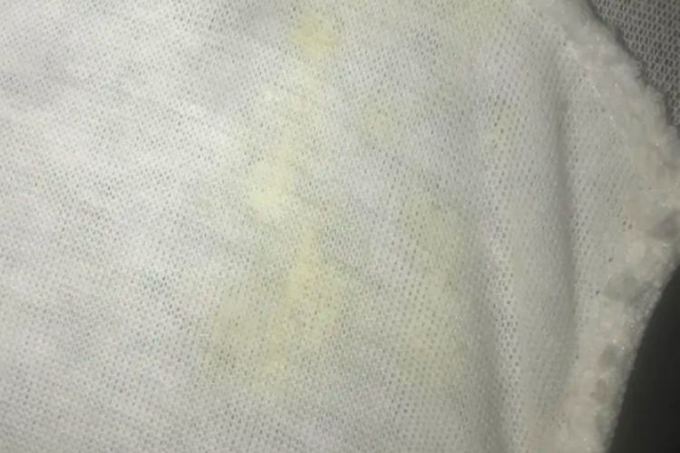 男性淋菌性尿道炎绿色分泌物图