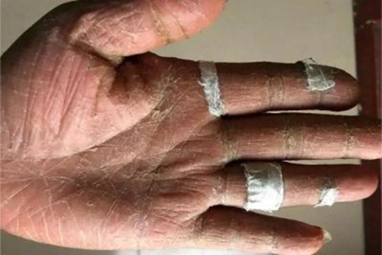 副肿瘤性肢端角化症手指脱屑图