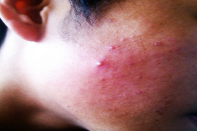 多囊卵巢综合征面部小疙瘩图