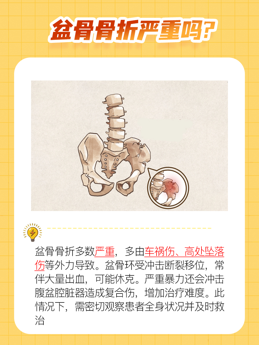 一文解析,盆骨骨折严重吗?