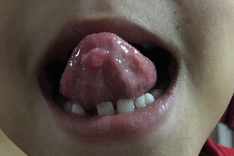 小孩舌下腺囊肿图