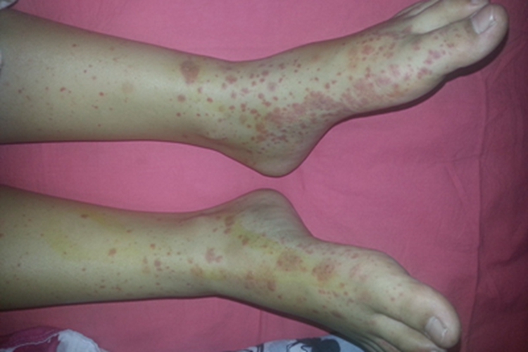 变应性皮肤血管炎脚上有红点图