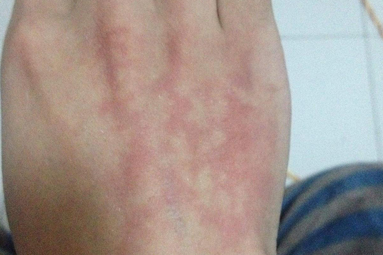 洗衣液过敏亚急性症状图