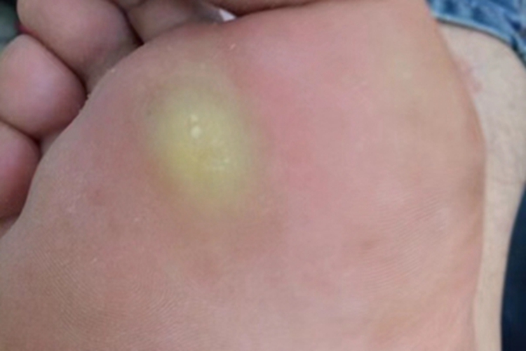 胼胝脚底一块皮肤增厚变黄图