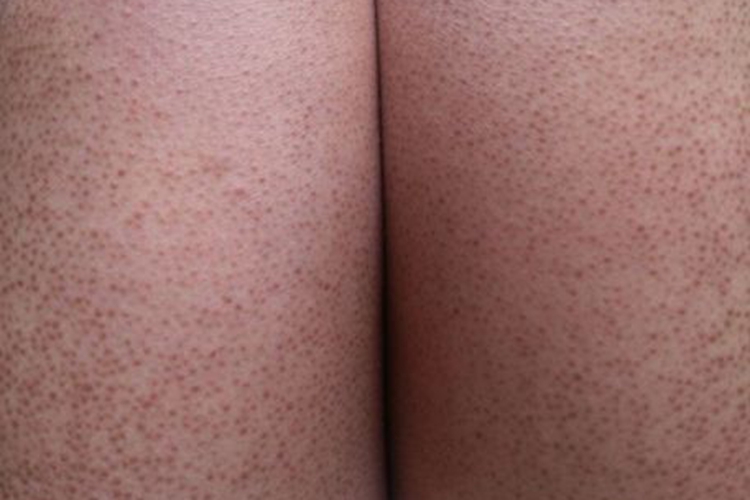 腿部严重毛周角化病图 腿部严重毛周角化病图