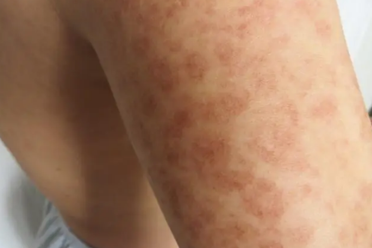 胳膊毛细血管环状紫癜图