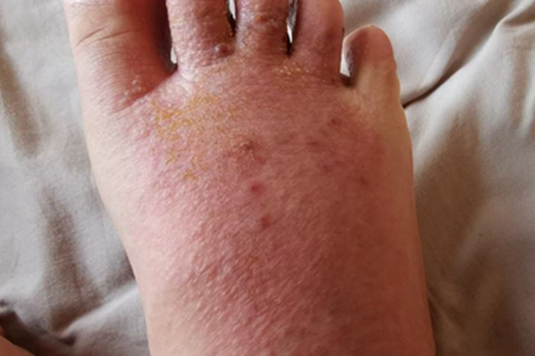 柯萨奇湿疹脚背症状图 柯萨奇湿疹脚背症状图