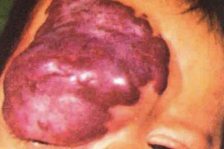 毛细血管瘤眼周症状图 毛细血管瘤眼周症状图