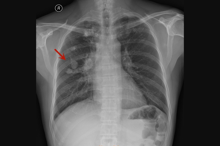 已经钙化的肺结核图