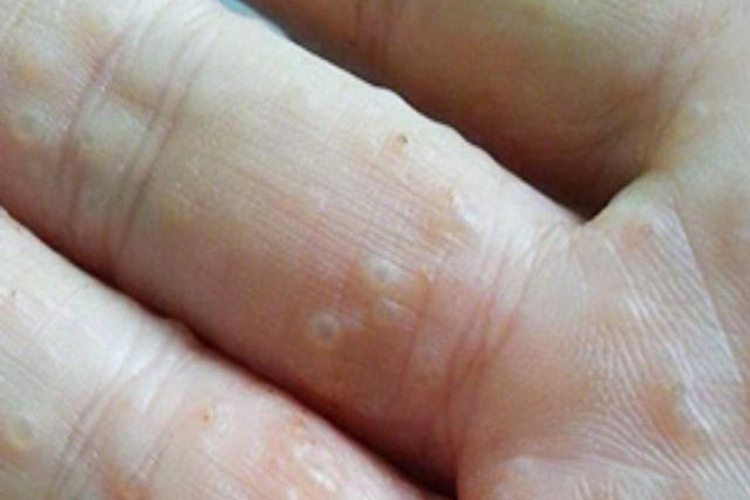 手部汗疱疹图