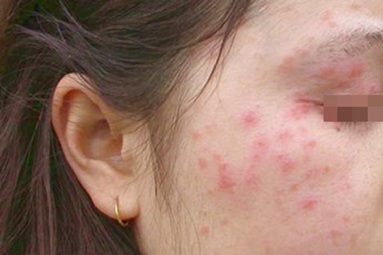 职业性光毒性接触性皮炎面部疙瘩图<br />
