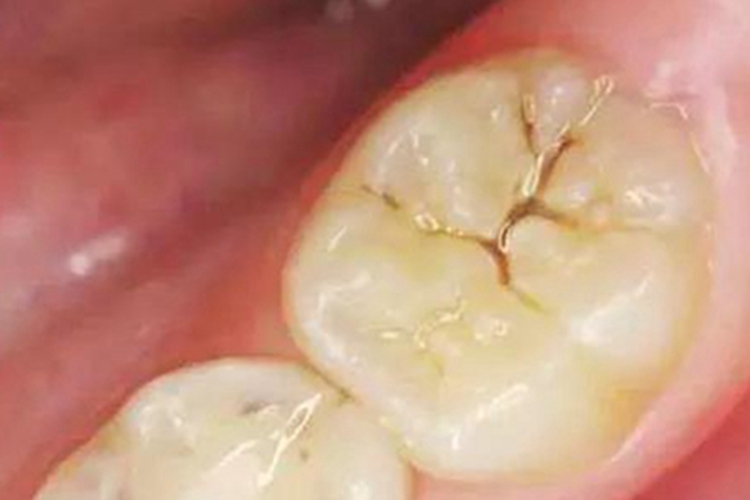 浅龋牙齿出现褐色裂纹图