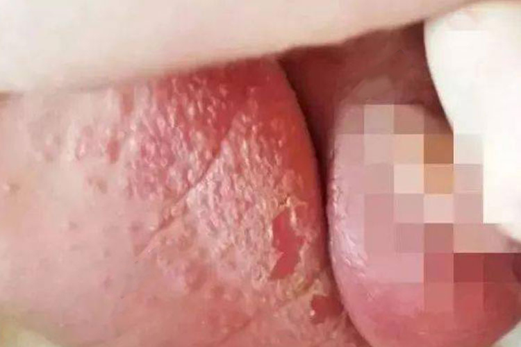 臀部的过敏性丘疹图
