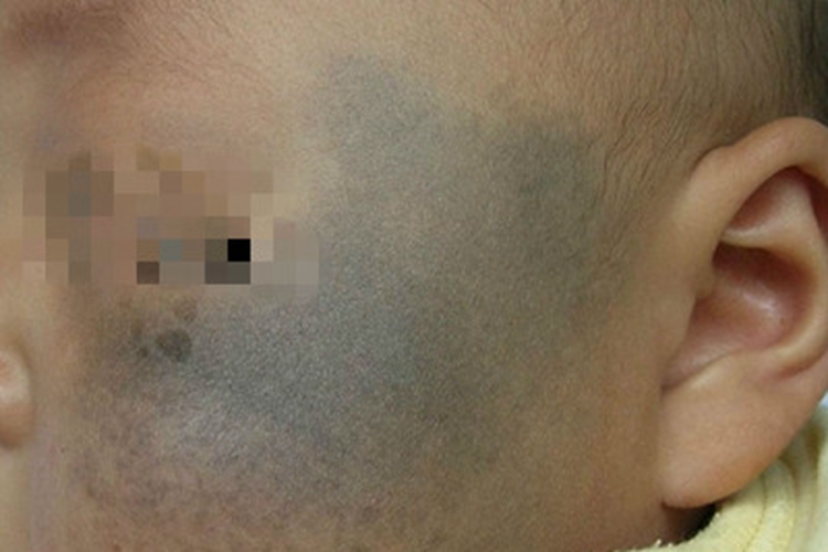 伊藤痣面部有大面积青斑图