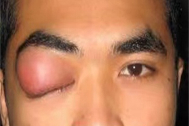 慢性泪腺炎症状图