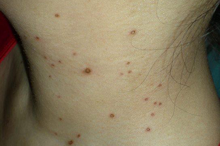 孩子脖子上长扁平疣图