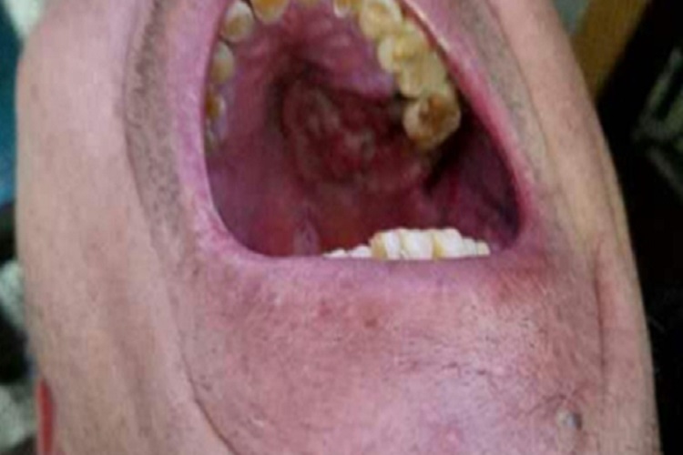 晚期上颌窦癌硬腭隆起图