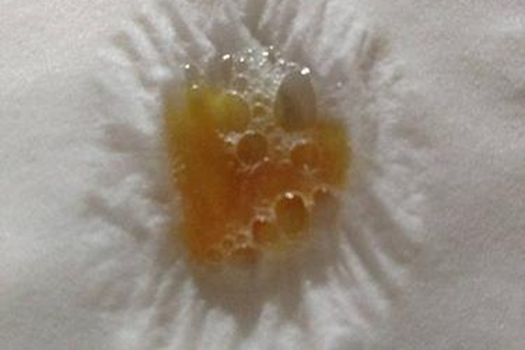 过敏性支气管肺曲霉菌病棕色痰图