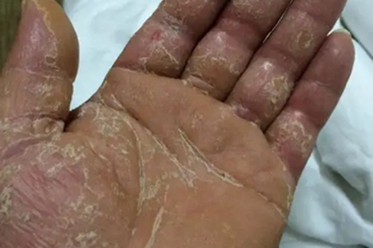 进行性掌跖角化病脱屑图 进行性掌跖角化病脱屑图