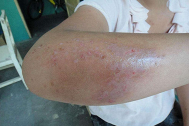 自身敏感性皮炎胳膊斑图