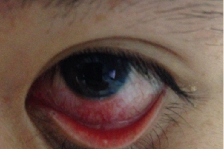 麻疹结膜充血图