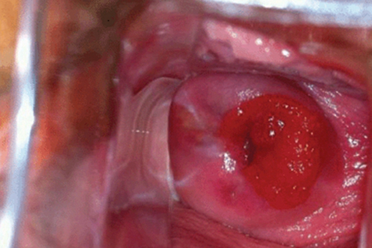 中度宫颈柱状上皮异位 中度宫颈柱状上皮异位