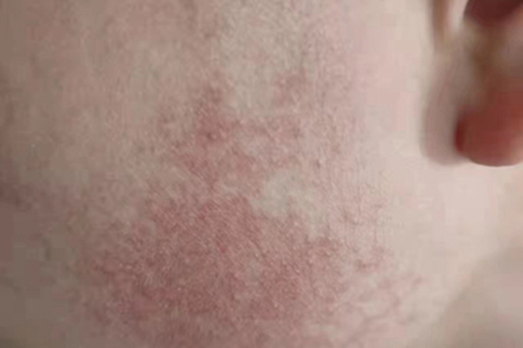 毛发苔藓面部有密集小红丘疹图