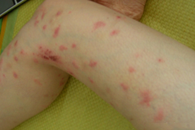 虫咬皮炎风团图 虫咬皮炎风团图
