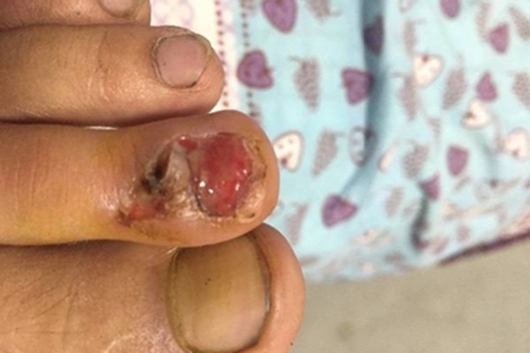 甲床炎脚趾甲症状图 甲床炎脚趾甲症状图