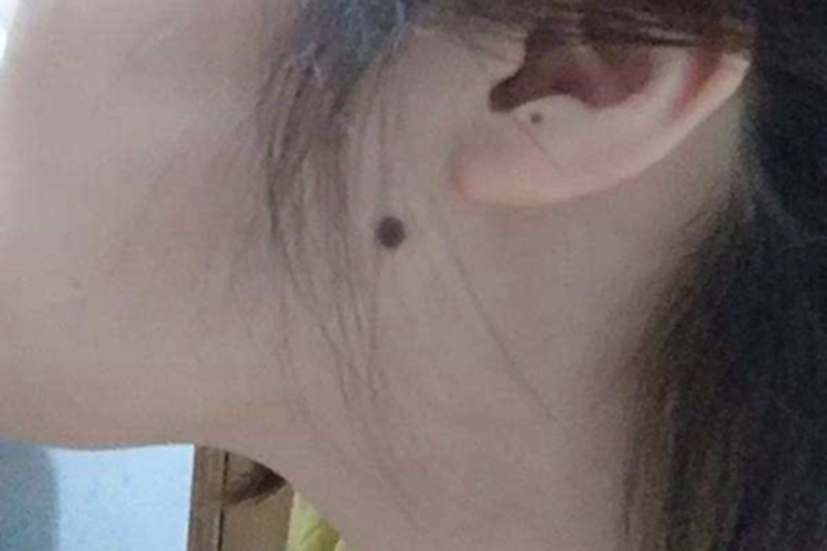 交界痣耳周症状图