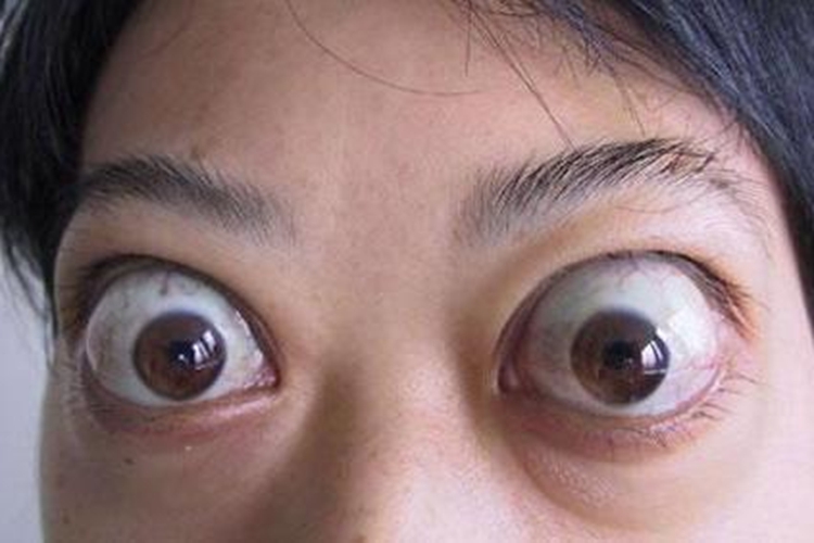 甲亢的图片是什么样子