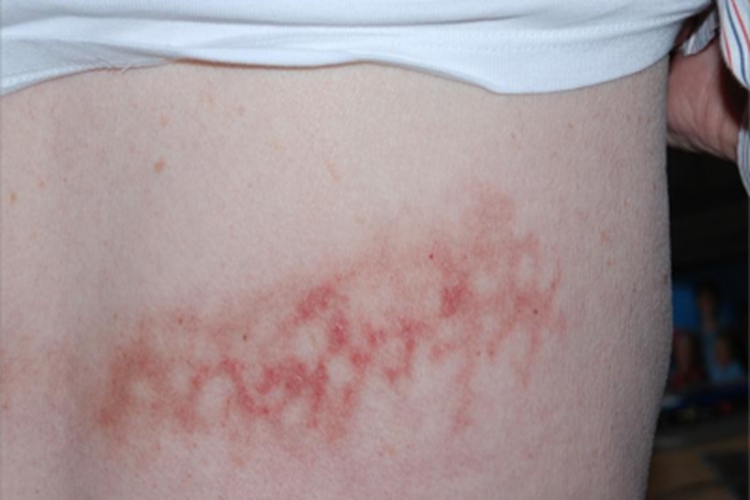 热激红斑症状图