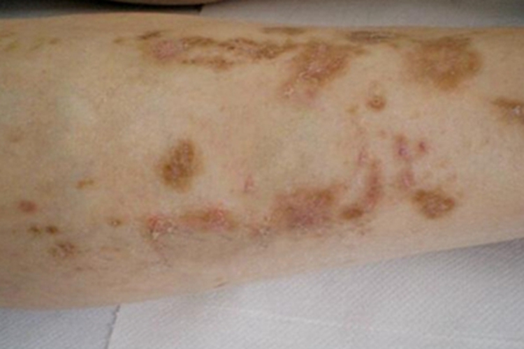 糖尿病性皮肤病斑图