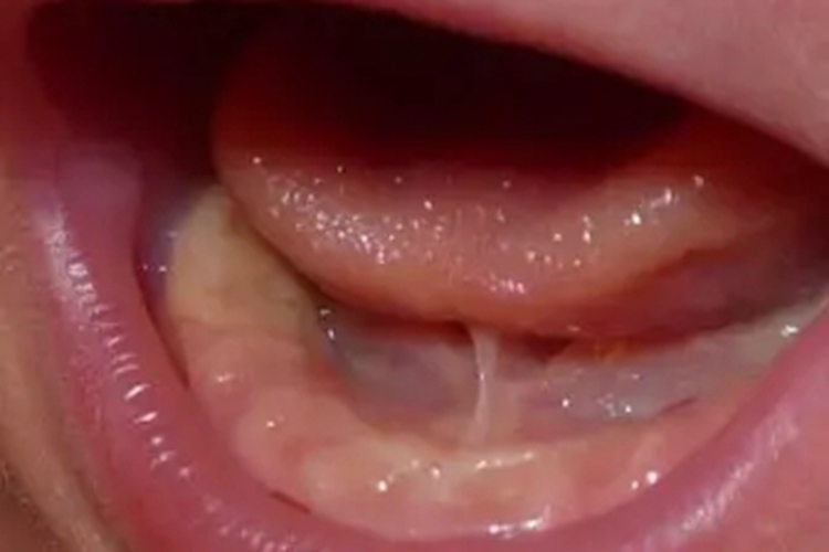 婴儿舌头下面正常图 婴儿舌头下面正常图