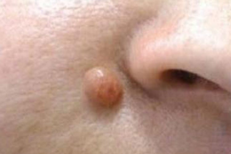 脸上皮肤纤维瘤