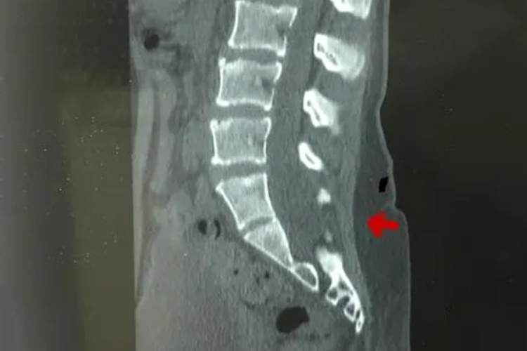 隐性脊柱裂影像图