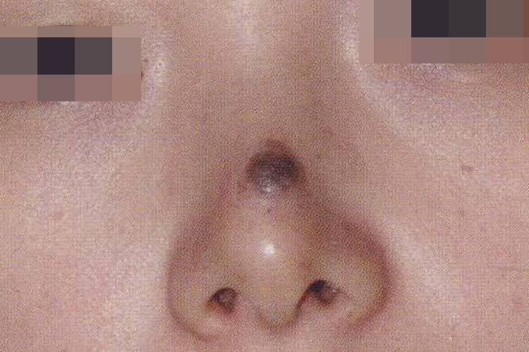 鼻子上有褐色纤维瘤图 鼻子上有褐色纤维瘤图