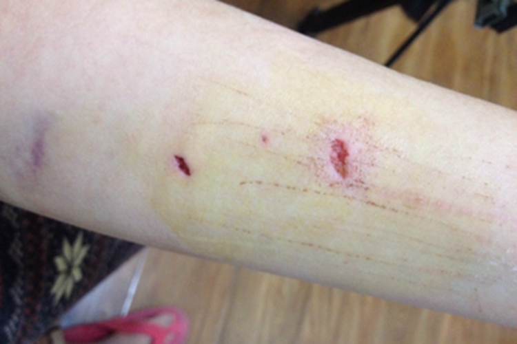 戳伤胳膊中间凹陷图